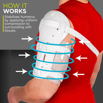 A Sarmiento Humerus Fracture Brace compresses the muscle around the broken arm acting as a splint